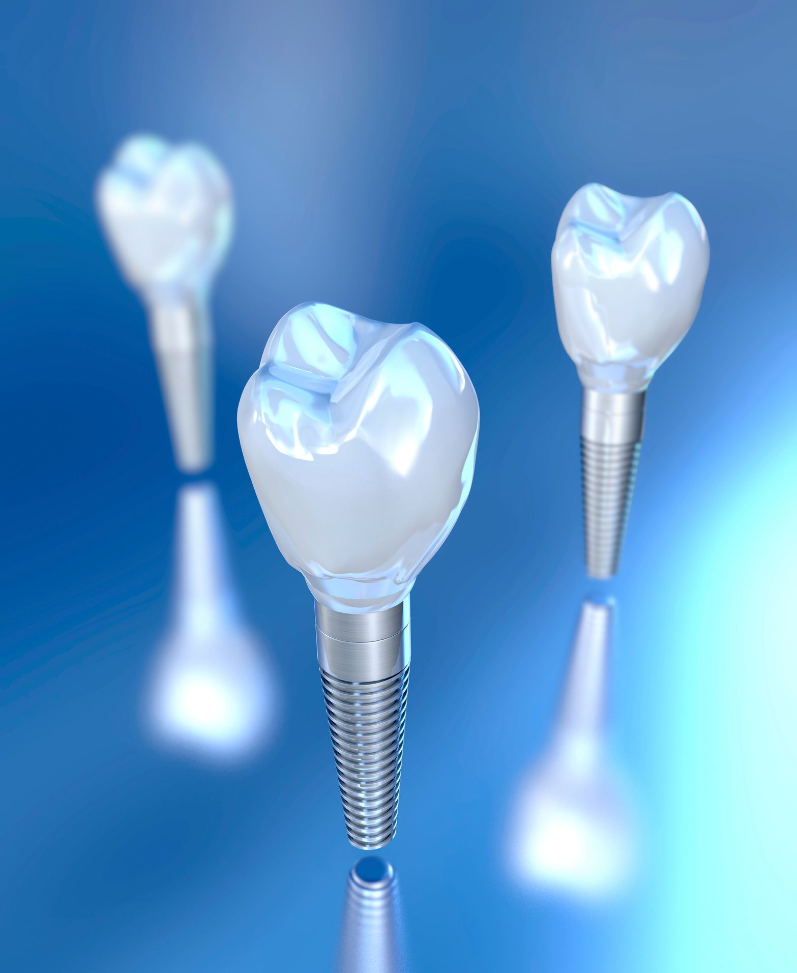 Implantologia dentale Messina
